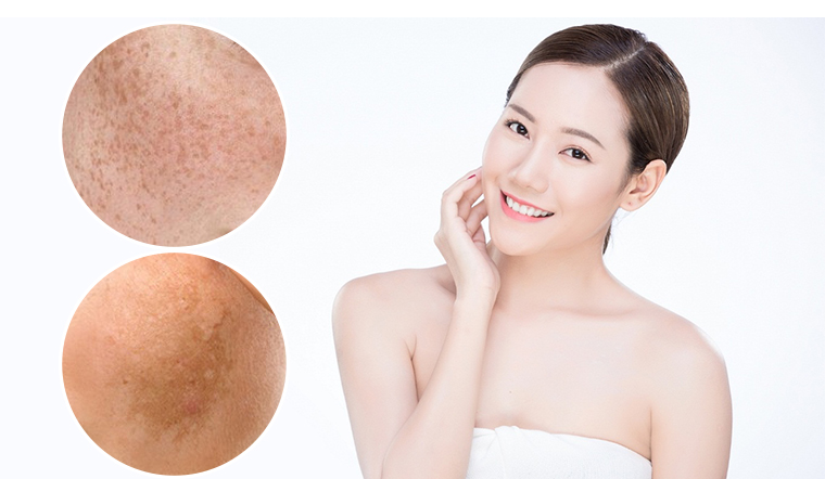 Làm trắng da và chống thâm nám