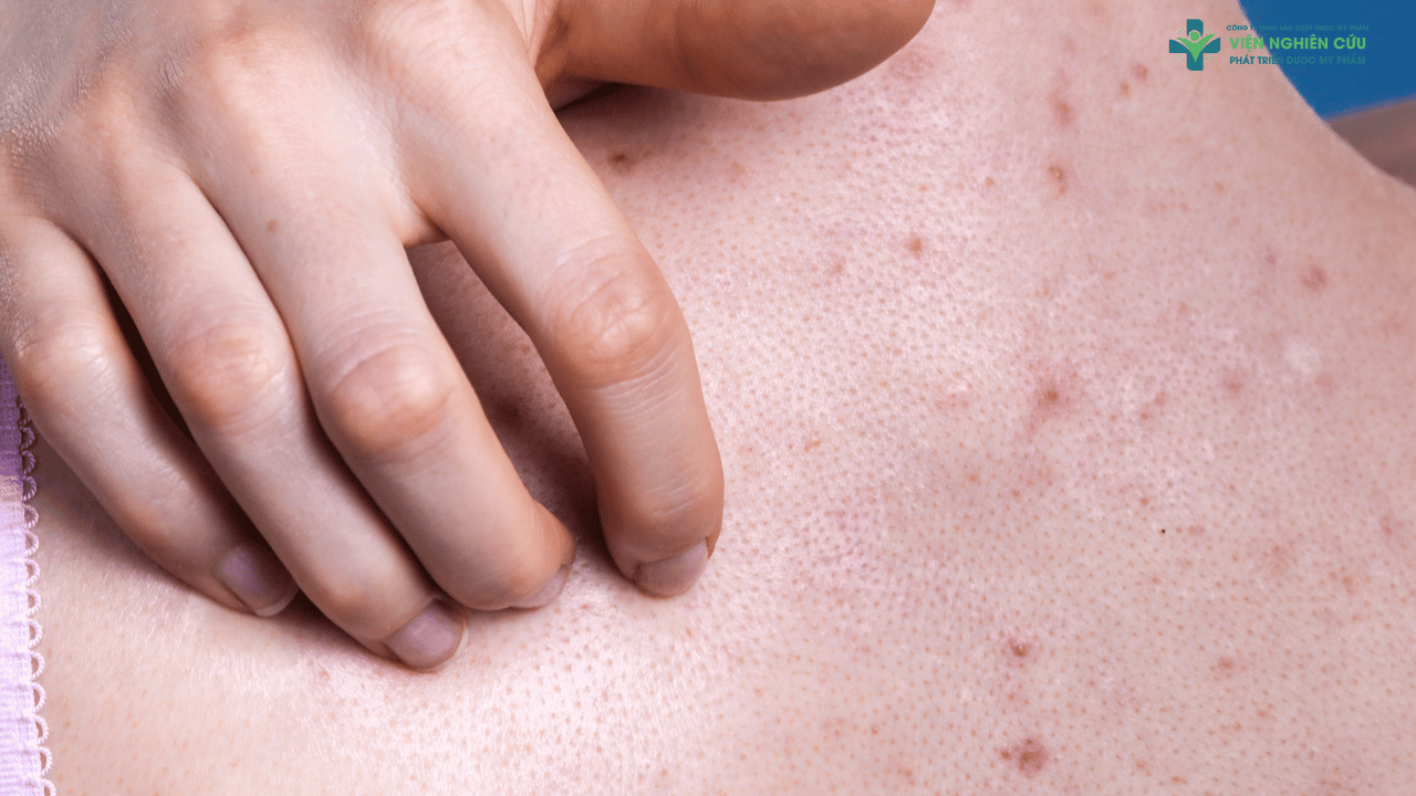 Nguyên nhân gây mụn lưng – Đừng bỏ qua!