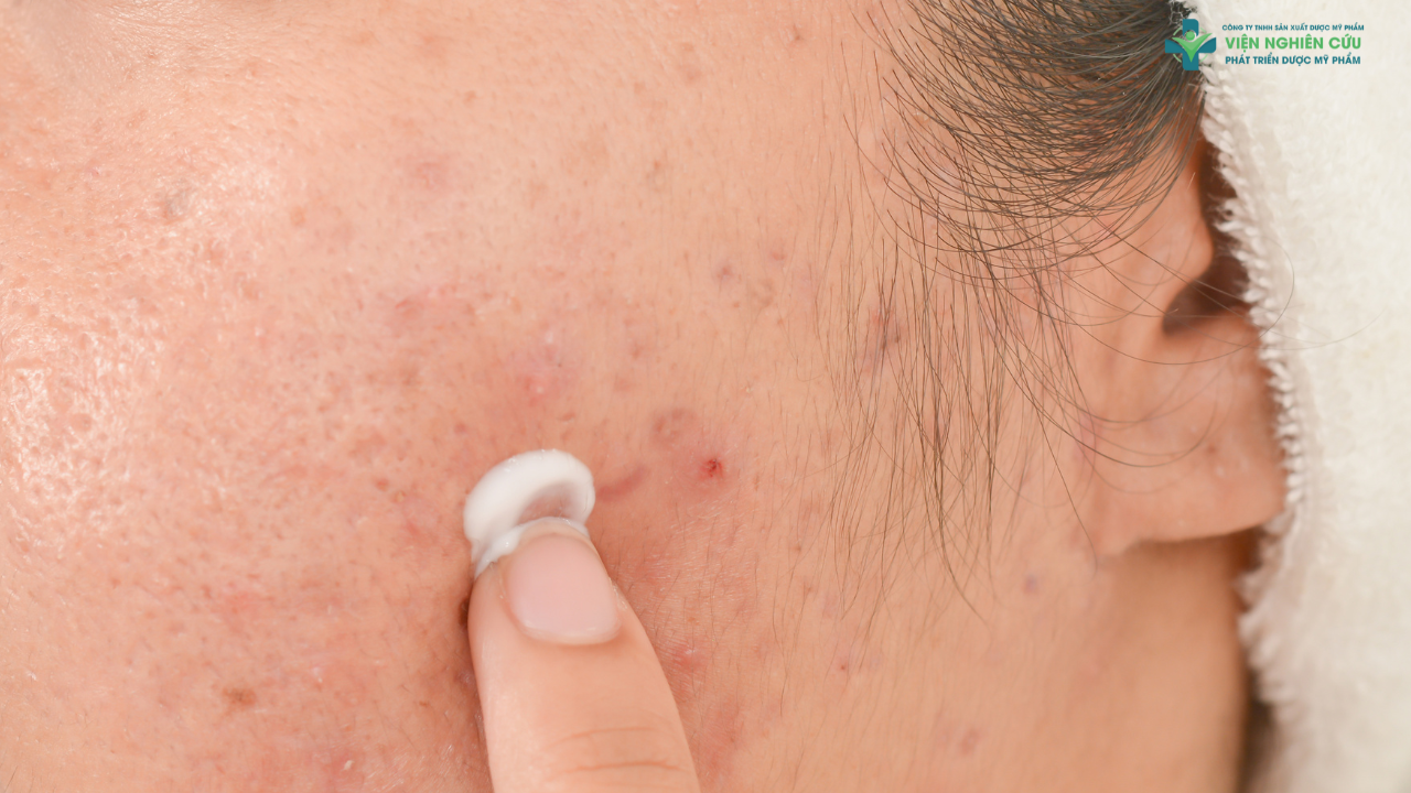 Những ai nên dùng kem chấm mụn