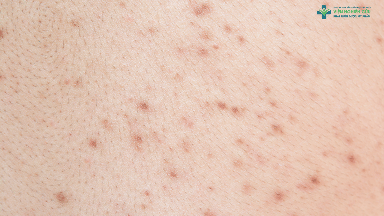 Tại sao mụn lưng xuất hiện