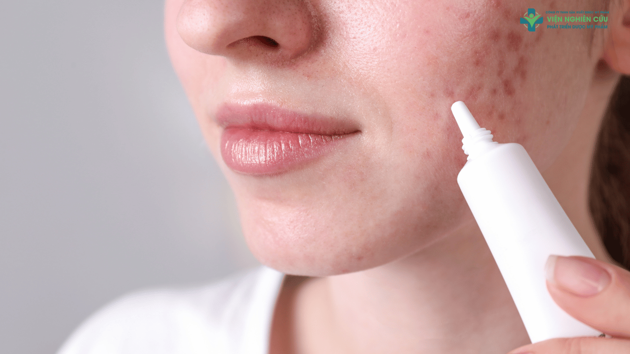 Thuốc chấm mụn là gì_ – Nhìn từ góc độ khoa học và lâm sàng