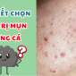 Bi quyet chon kem tri mun trung ca chuan phong lab – Goc nhin tu chuyen gia gia cong my pham 85x85
