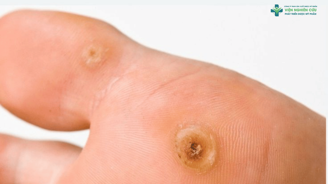 Đối tượng nên sử dụng chấm mụn cóc Nga