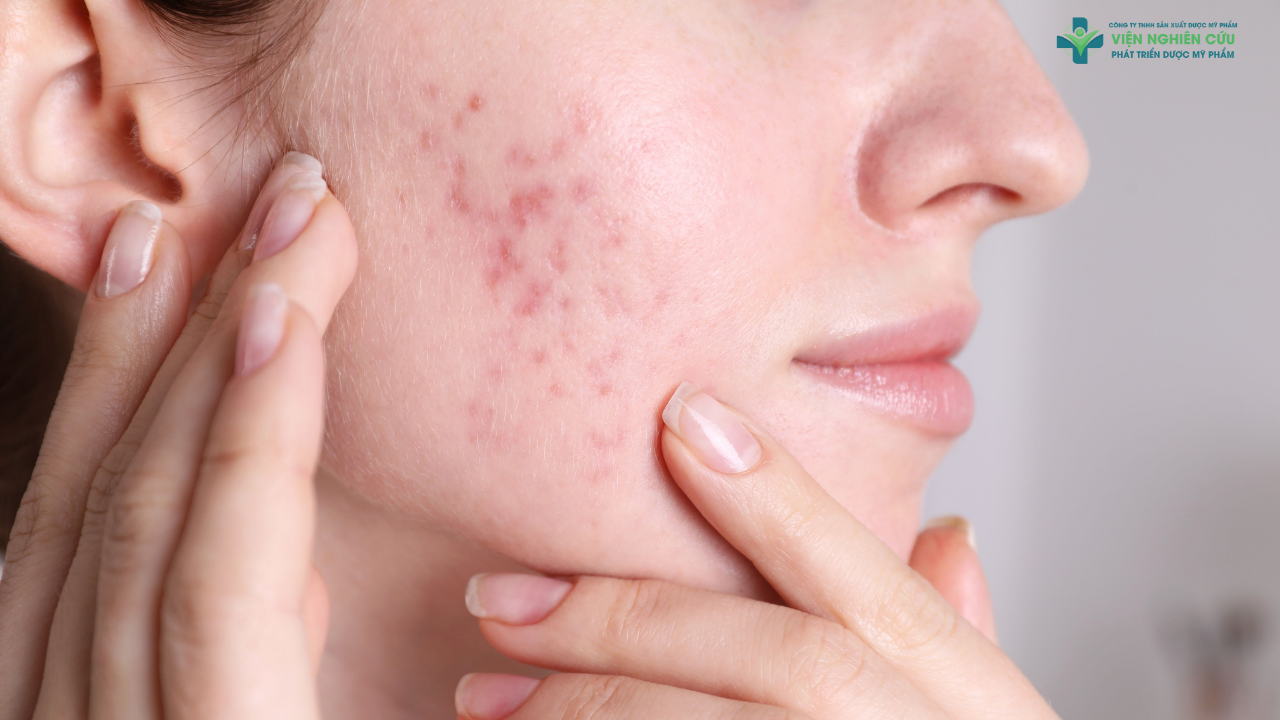 Gợi ý chu trình chăm sóc da kết hợp cùng chấm mụn Azaduo