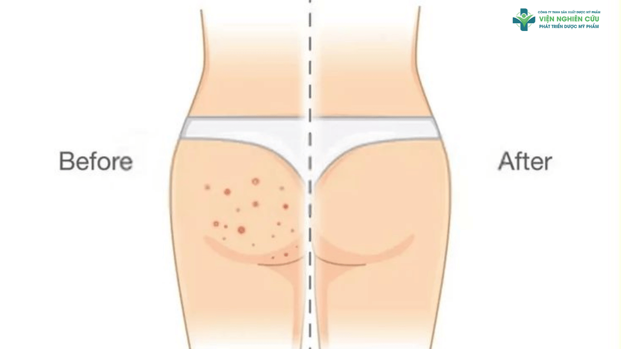 Kem trị mụn mông – Giải pháp cho nỗi khổ “khó nói”