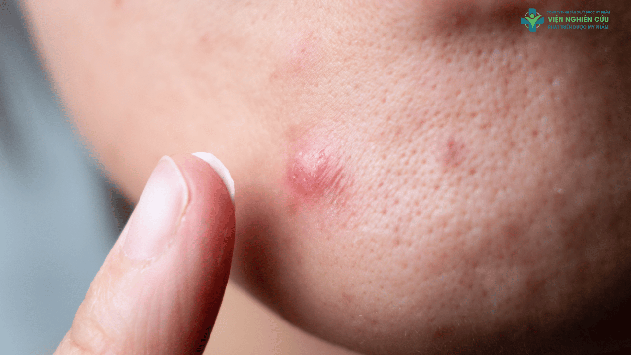 Vì sao kem trị mụn trứng cá dễ gây nhầm lẫn khi chọn mua