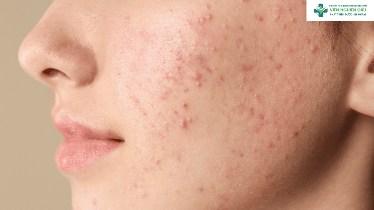 Ai nên sử dụng Igreen serum trị mụn