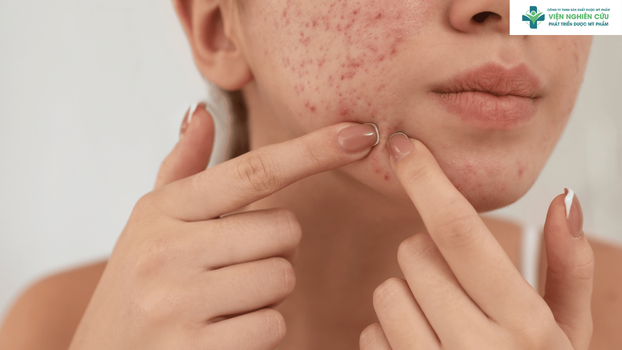 Đối tượng sử dụng kem chấm mụn Decumar 