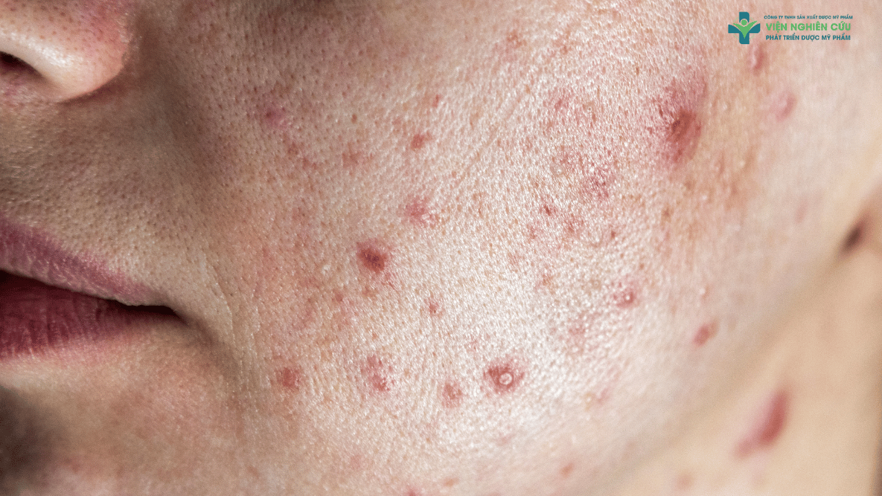 Đối tượng phù hợp với Igreen diếp cá