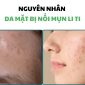 Nguyen nhan da mat bi noi mun li ti 85x85