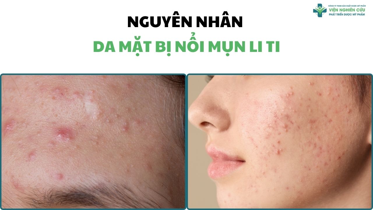 Nguyên nhân da mặt bị nổi mụn li ti