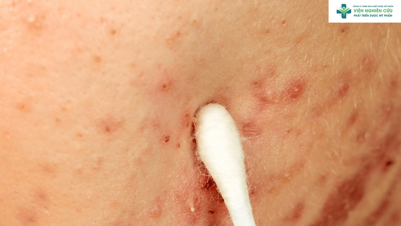 Những điều da mụn cần lưu ý