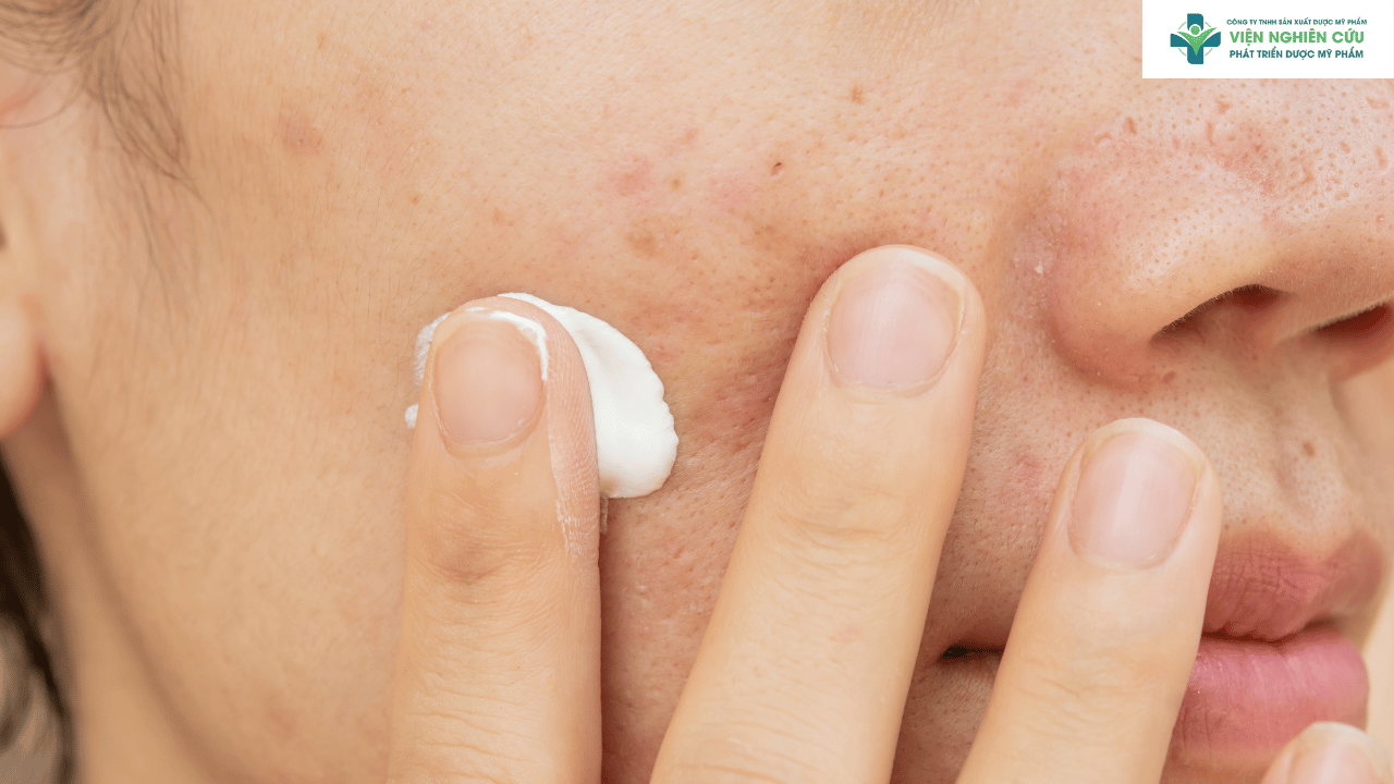 Vì sao cần dùng sản phẩm trị thâm mụn