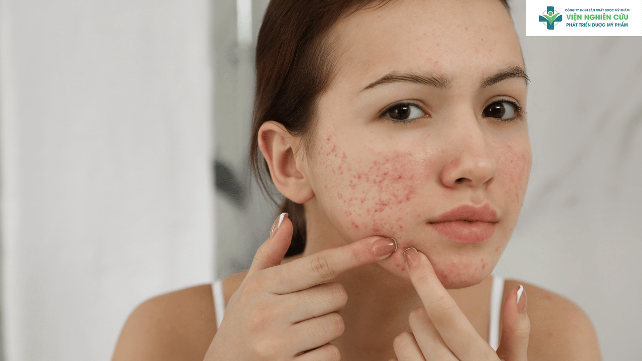 Vì sao da tuổi dậy thì cần serum