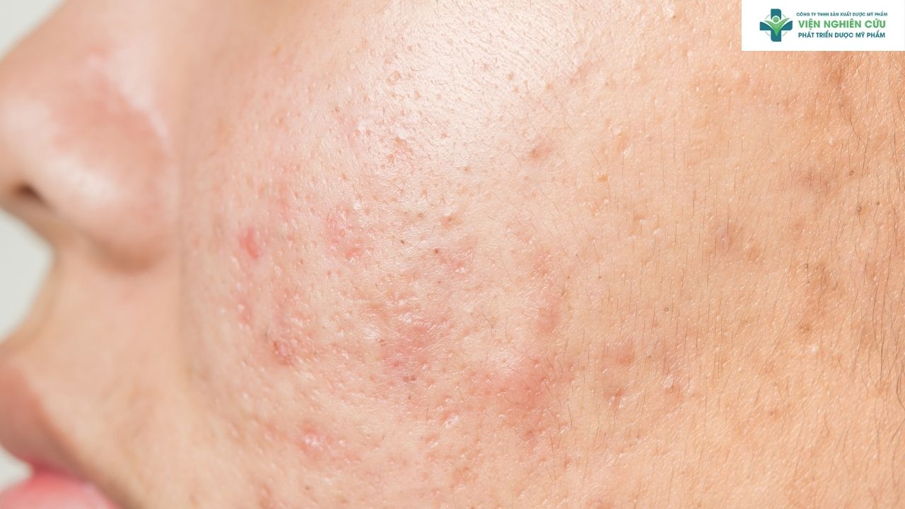 Vì sao mặt bị nổi mụn li ti