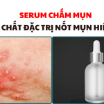 Serum chấm mụn – Tinh chất đặc trị nốt mụn hiệu quả