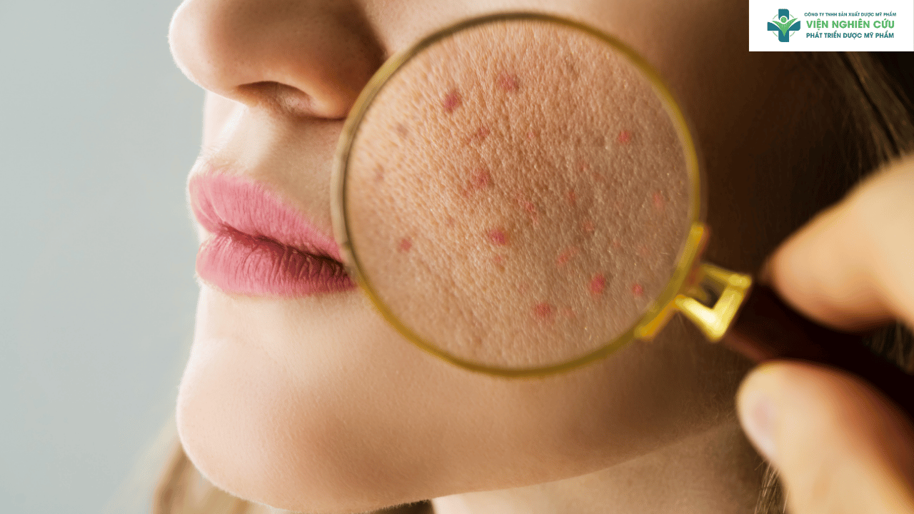 Vì sao nên dùng serum chấm mụn?